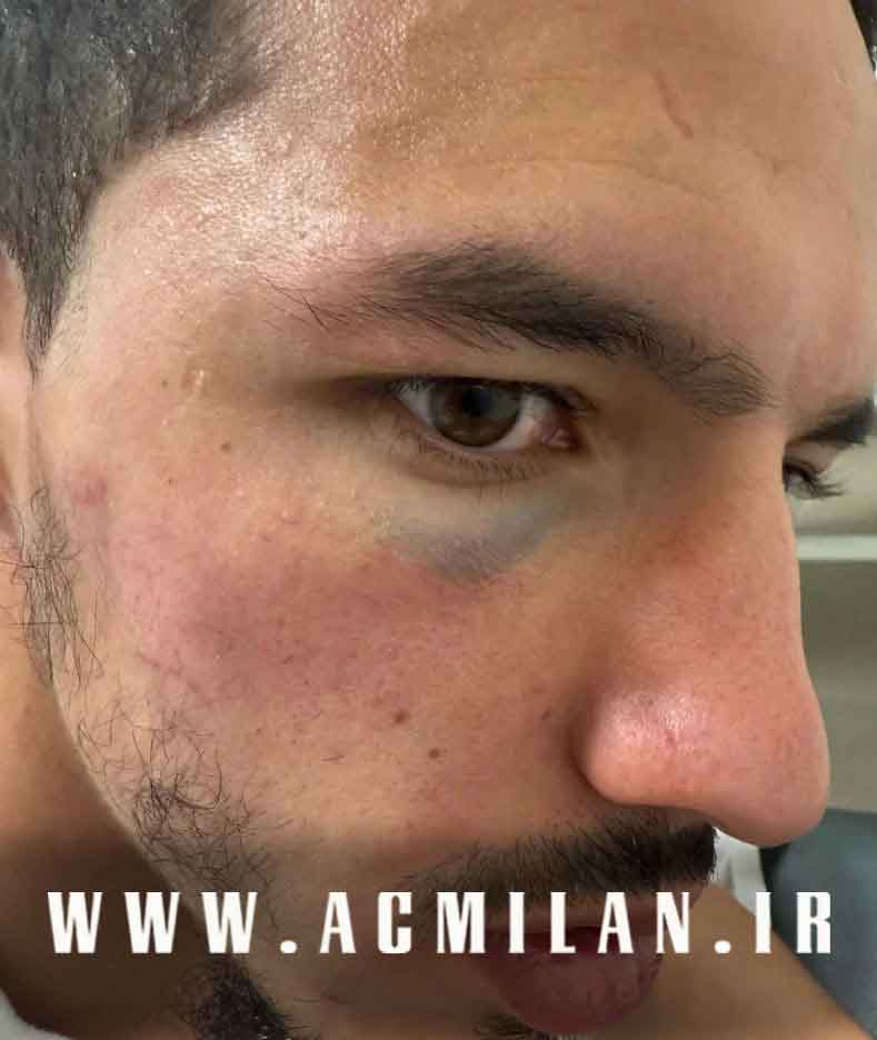 تصاویر شوکه کننده: بن ناصر این گونه بَدنش را فدای میلان می کند